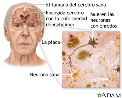 alzheimer y incontinencia