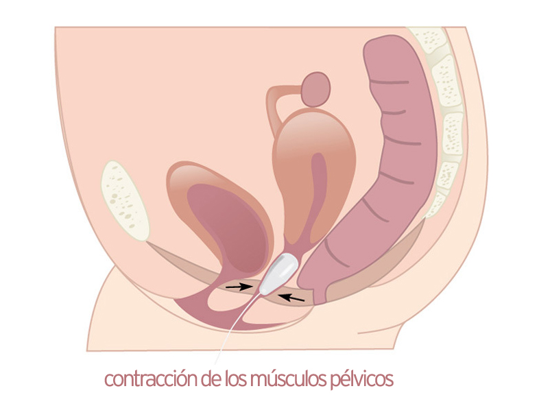 Conos Vaginales